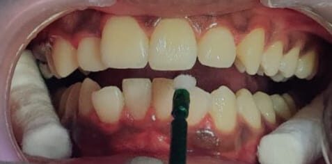 Fluoride: Is It Safe for Children?